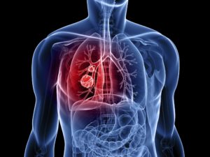 Life Saving Lung Cancer Screenings at TRA Medical Imaging