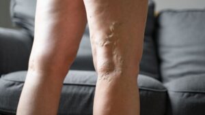 Understanding Varicose and Spider Veins: Causes, Symptoms, and Minimally Invasive Treatments