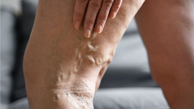 Varicose Veins