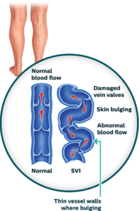 Understanding and Treating Unsightly or Painful Vein Issues: What You Need to Know 1