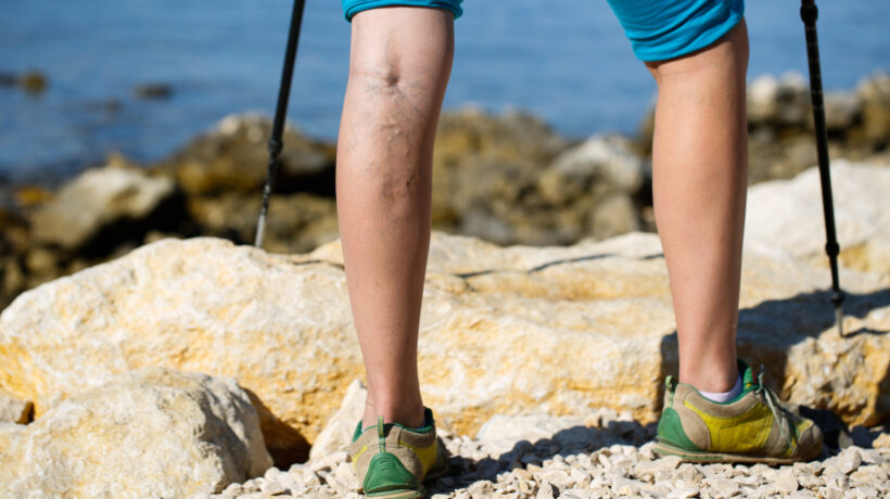 Understanding and Treating Unsightly or Painful Vein Issues: What You Need to Know